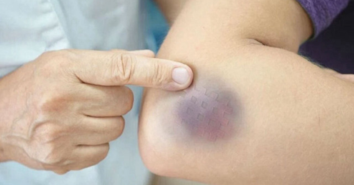 Vücuttaki Morluklar Neden Olur, Nasıl Daha Hızlı Geçer Ve Ne Zaman Ciddiye Alınmalı1 Gencgazete