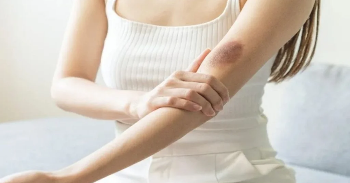 Vücuttaki Morluklar Neden Olur, Nasıl Daha Hızlı Geçer Ve Ne Zaman Ciddiye Alınmalı2 Gencgazete