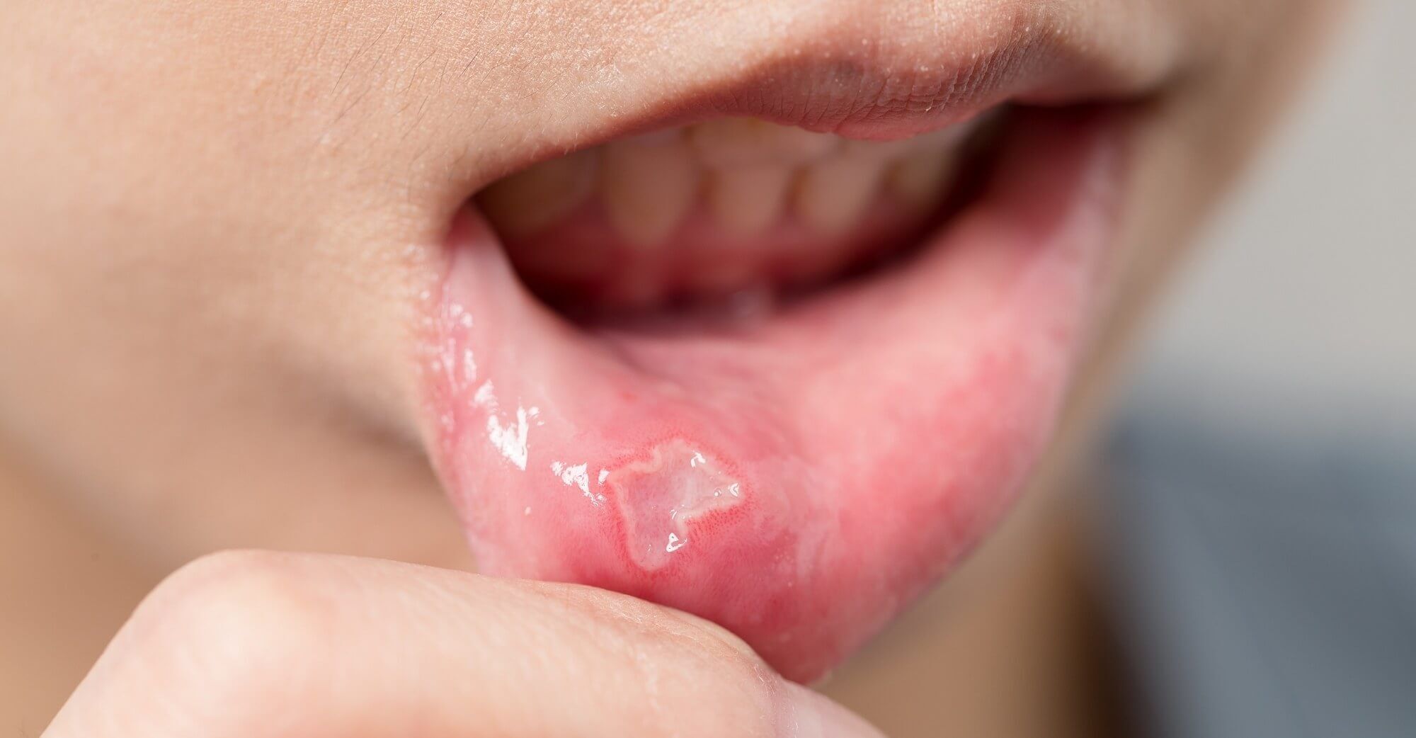 Ağız Içinde Çıkan Yaralar Çoğu Zaman Önemsenmez; Ancak 3 Haftadan Uzun Süren Yaralar Ciddi Hastalıkların Habercisi Olabilir (2)