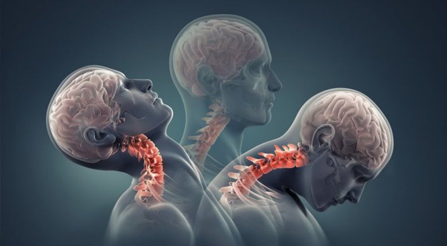 Ameliyatsız Bel Ve Boyun Fıtığı Tedavisi Mümkün Mü İşte Merak Edilen Gerçekler (2)