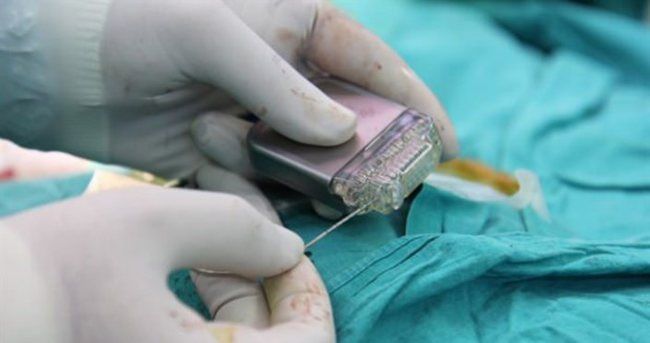 Beyin Pili Nedir, Kimlere Takılır Ve Gerçekten Hayatı Nasıl Değiştirir İşte Merak Edilen Tüm Detaylar! (1)