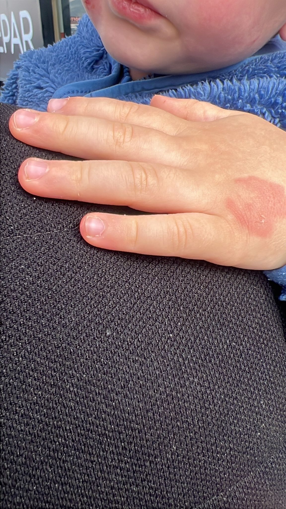 Bursa'da Kreşe Bıraktığı Çocuğunu Darp Edilmiş Halde Aldı (2)