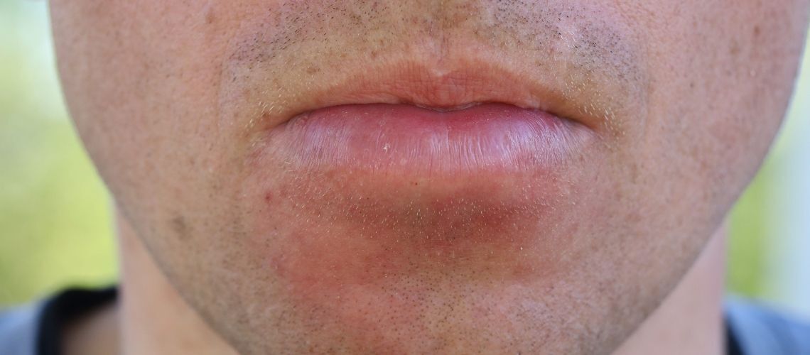 Dudak Şişmesi Neden Olur, Basit Bir Sorun Mu Yoksa Ciddi Bir Hastalığın Habercisi Mi (2)