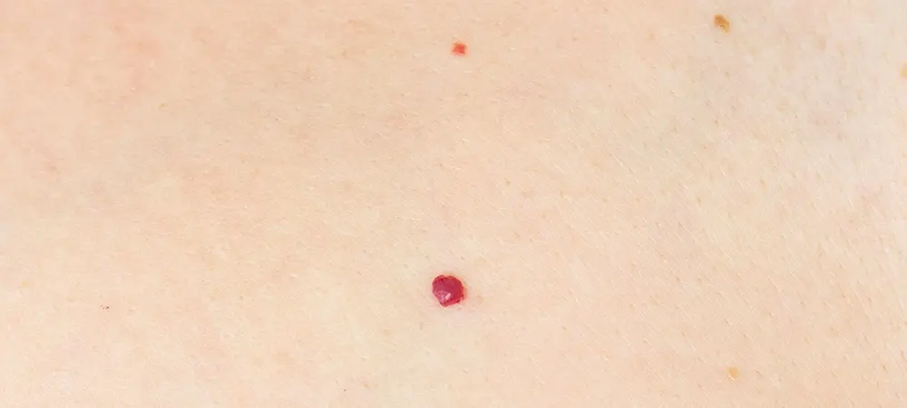 Kırmızı Ben Nedir, Neden Çıkar Kanser Riski Var Mı İşte Bilmeniz Gerekenler! (1)-1