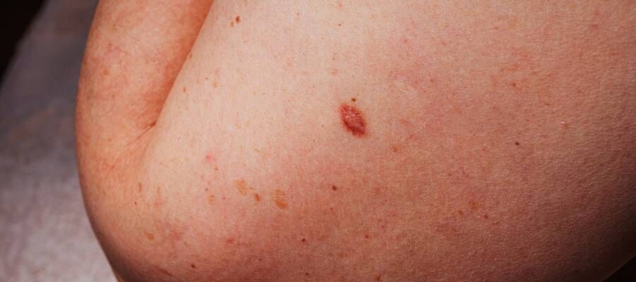 Kırmızı Ben Nedir, Neden Çıkar Kanser Riski Var Mı İşte Bilmeniz Gerekenler! (2)