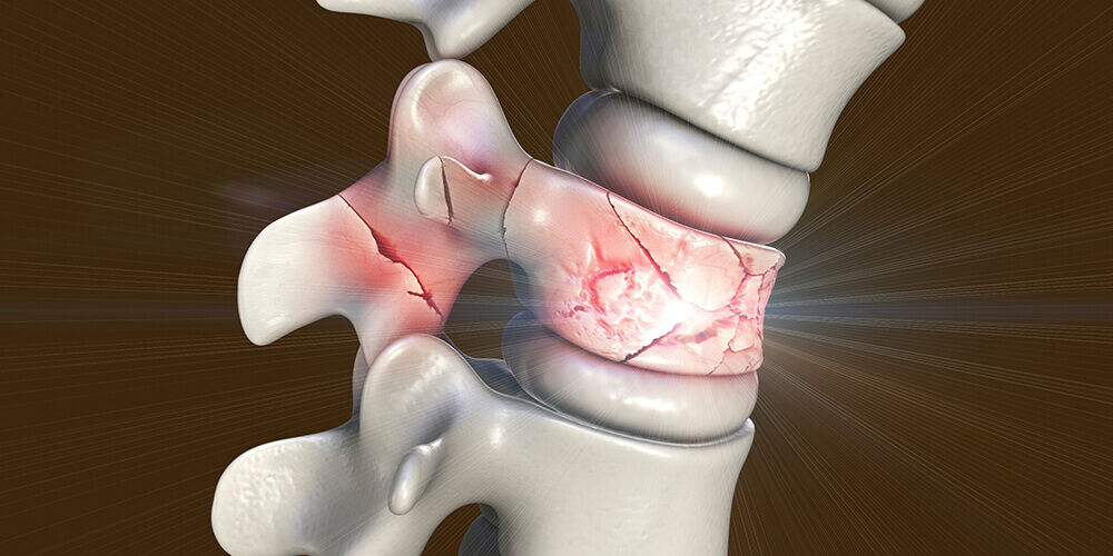 Omurga Kırıkları Nedir? Omurga Kırığı Neden Olur Ve Tedavisi Nasıl Yapılır?