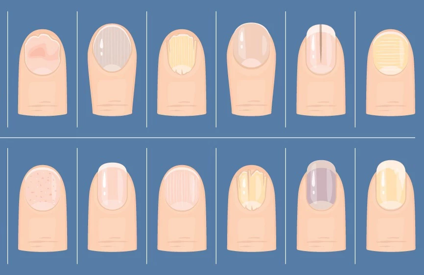 Tırnaklardaki Değişimler Ne Anlama Geliyor Renk, Şekil Ve Kırılmalar Hangi Hastalıkların Habercisi Olabilir (2)