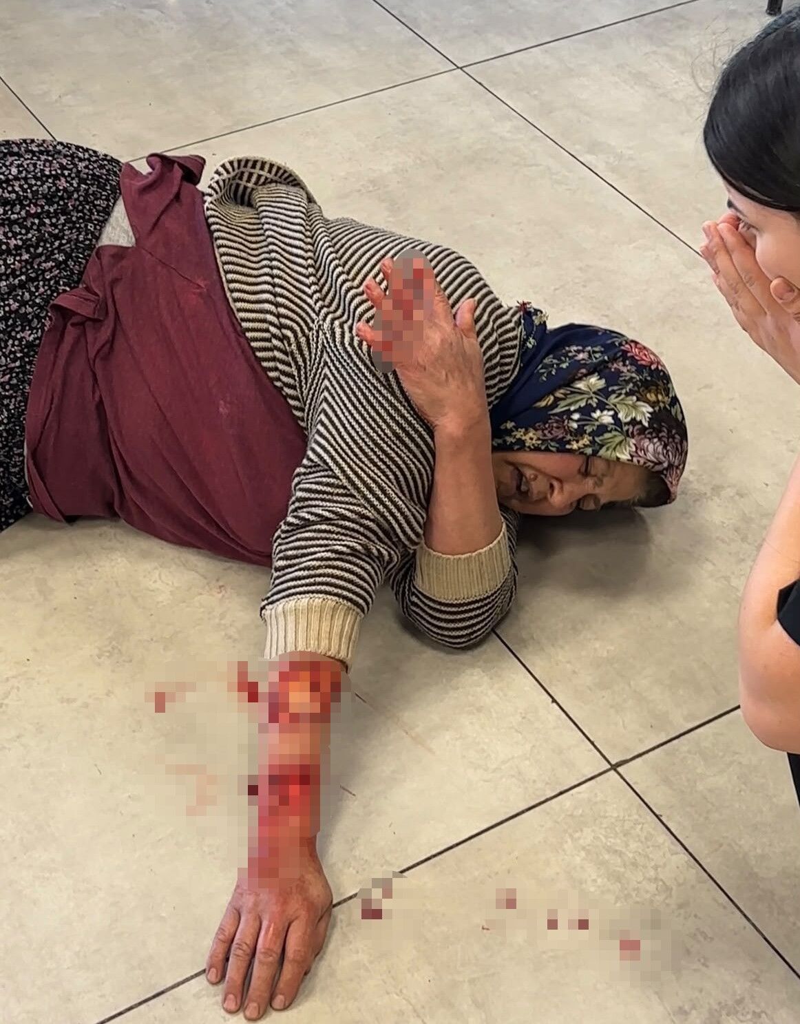Tekmelere Aldırmayan Köpek Kadının Kolunu Kopardı (2)