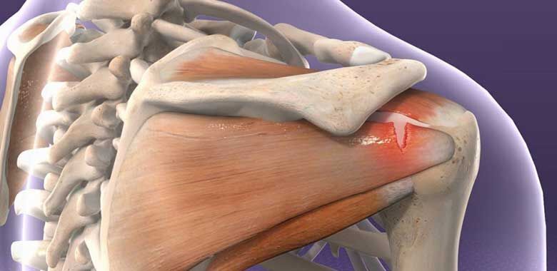 Omuzun En Hareketli Noktası Glenohumeral Eklem Nedir İşte Bilmeniz Gerekenler (2)