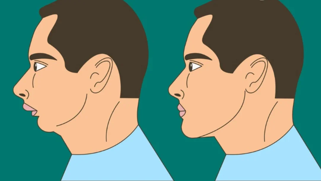 Mewing Nedir, Nasıl Yapılır Çene Hattını Belirginleştirdiği İddiası Gerçek Mi-1