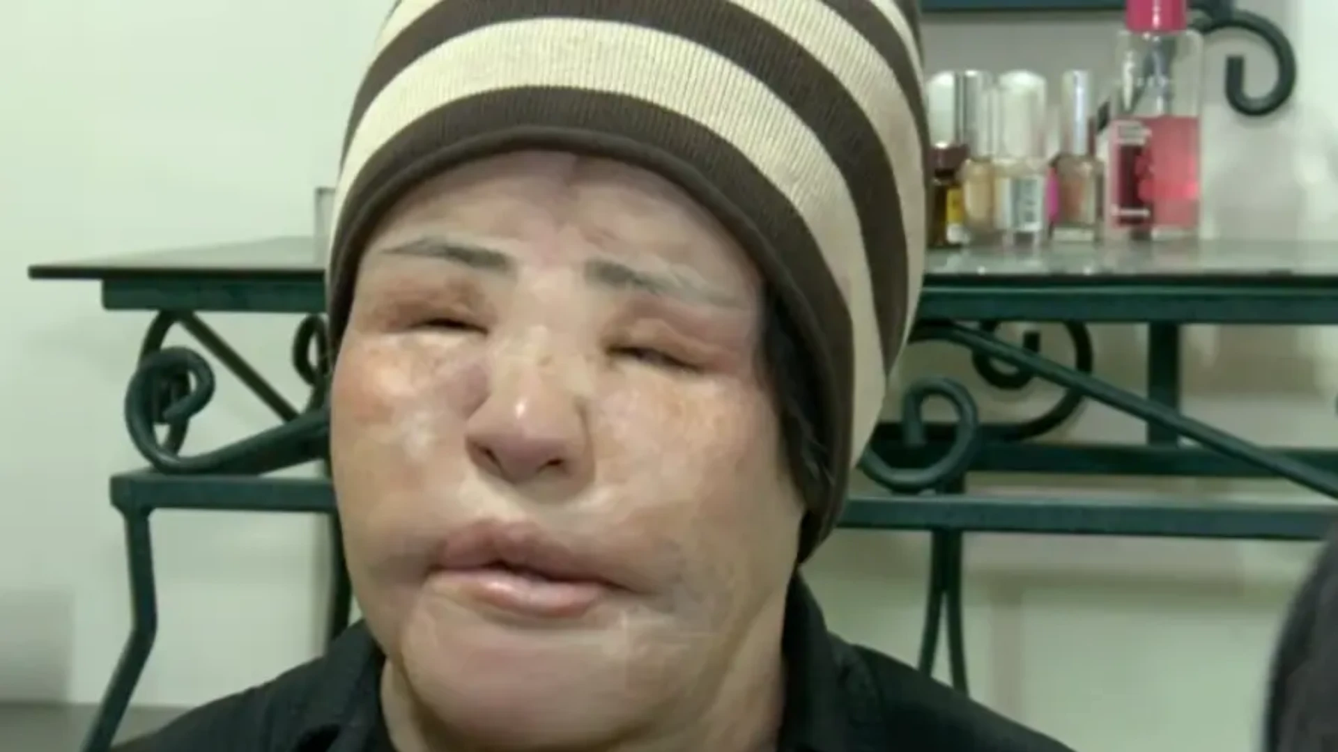 Doktorlar Ameliyatı Reddetti, Yüzüne Yemeklik Yağ Enjekte Etti Güzelleşmek Isterken Hayatı Kabusa Döndü S