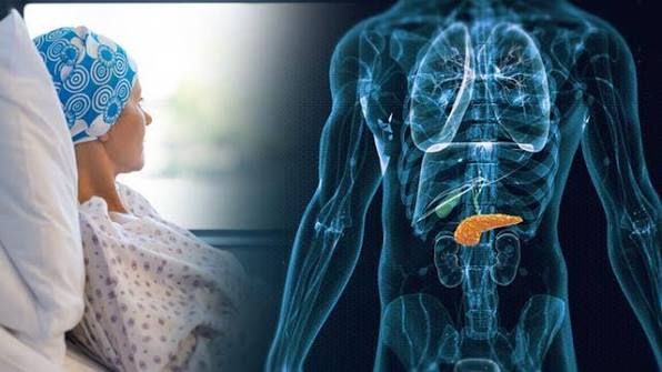 Pankreas Kanserinin Gözden Kaçabilen 6 Belirtisi! Bu İşaretlere Dikkatimages 5