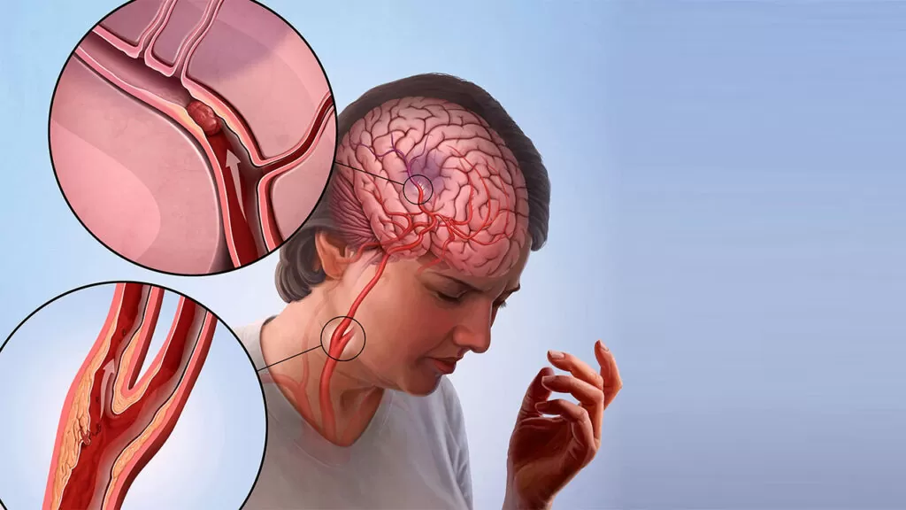 Robotik Rehabilitasyon Merkezi Inme Nasil Anlasilir Belirtileri Nelerdir U Vvg B Y Kpdm
